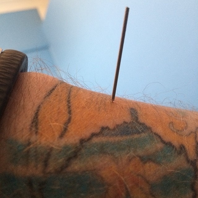 acupuncture needle